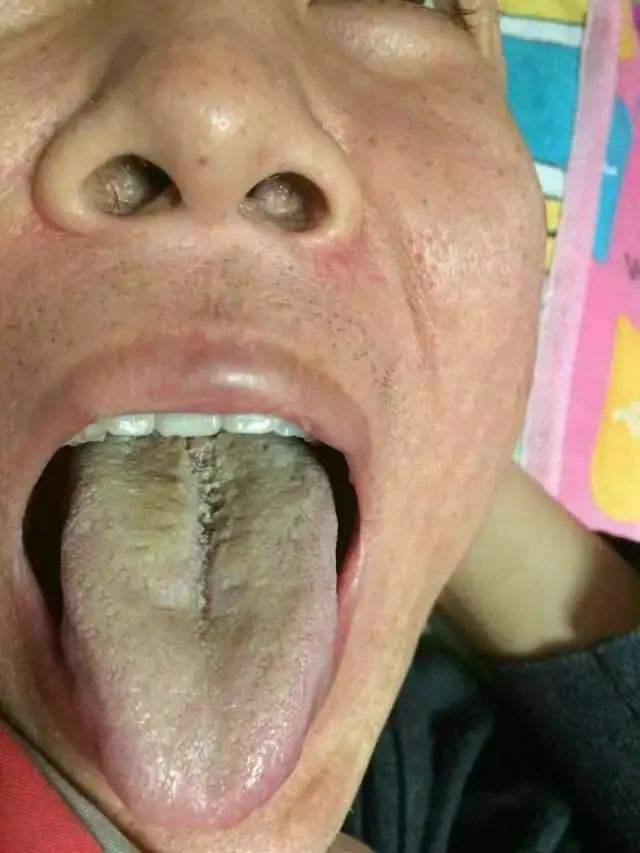 Foundations of Traditional Chinese Medicine: Phlegm-Dampness
