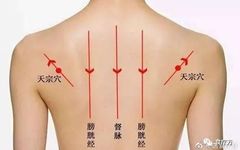 Comprehensive Guide to Cupping Therapy for the Back