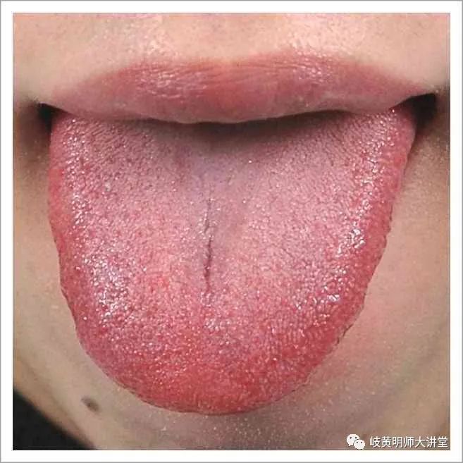 Traditional Chinese Medicine Tongue Diagnosis: Illustrated Guide to 14 Types of Tongue Shapes and Qualities