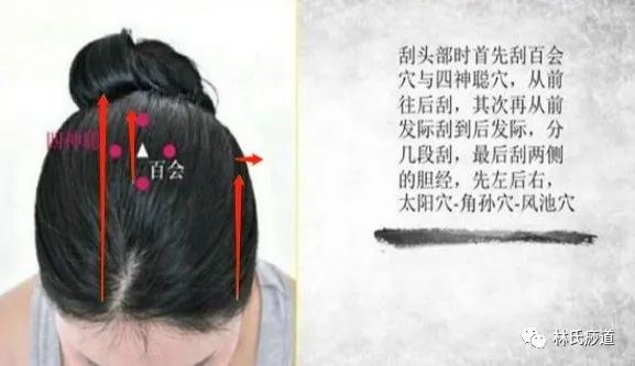 Key Points of Gua Sha