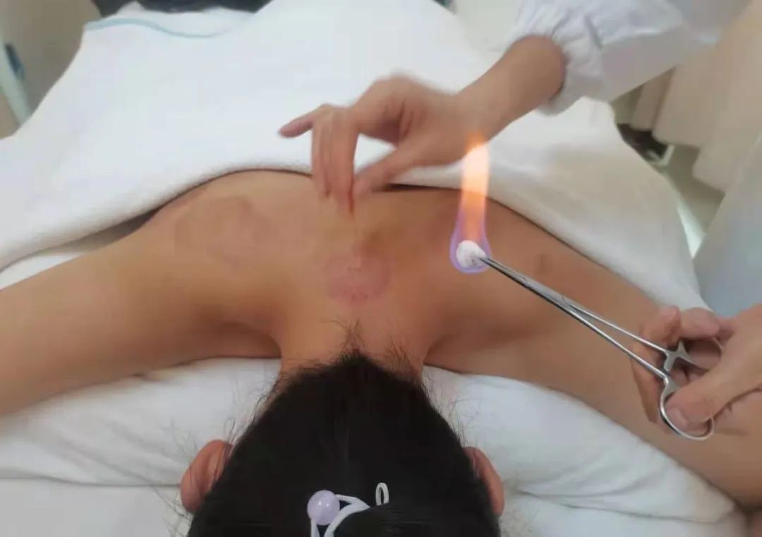 Fire Needle Therapy: A Unique TCM Approach