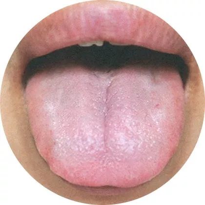 Comprehensive Guide to Tongue Diagnosis: A Must-Collect!