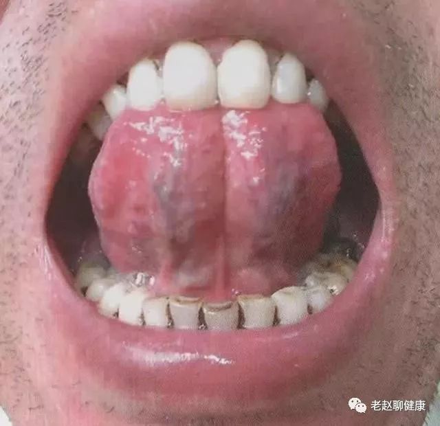 Tongue Diagnosis │ Sublingual Collaterals