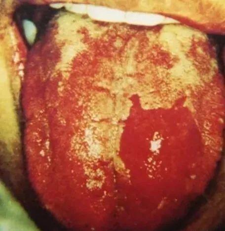 Comprehensive Guide to Tongue Diagnosis and Associated Conditions in TCM