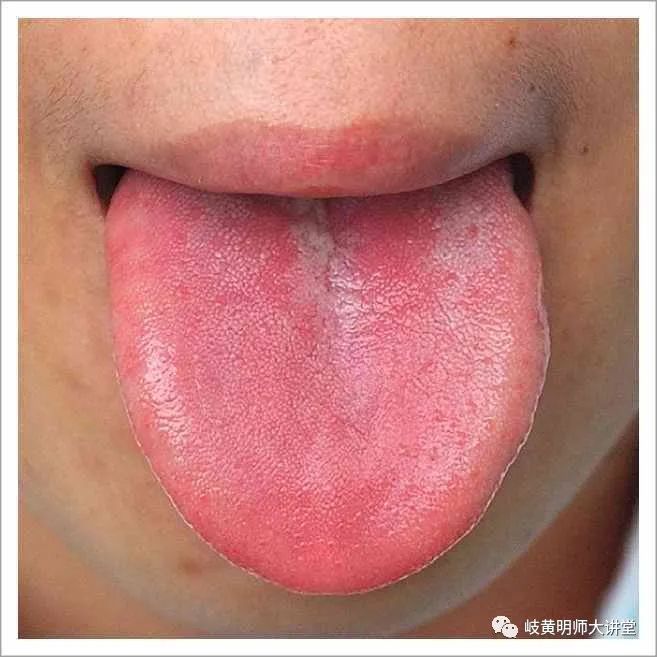 Traditional Chinese Medicine Tongue Diagnosis: Illustrated Guide to 14 Types of Tongue Shapes and Qualities