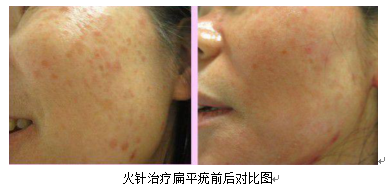 Fire Needle Therapy for Skin Diseases: Visible Safety and Efficacy