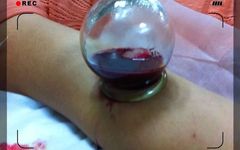 The Wonders of Bloodletting Therapy in Traditional Chinese Medicine