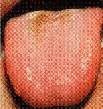 Tongue Diagnosis - Illustrated Guide to Tongue Manifestations