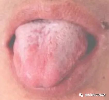 Tongue Diagnosis in Traditional Chinese Medicine: Tongue Coating