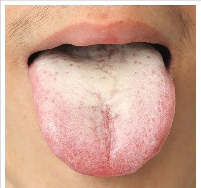 Traditional Chinese Medicine Tongue Diagnosis: 26 Clinical High-Definition Tongue Diagnosis Images with Analysis