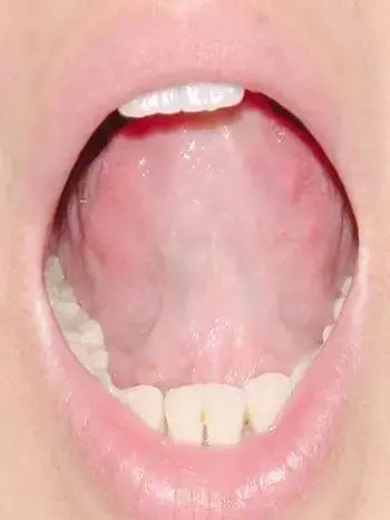 The Most Comprehensive Guide to Tongue Diagnosis! Master It and Become a Tongue Diagnosis Expert