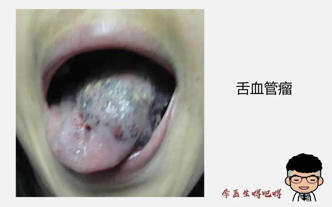 What Level of Tongue Diagnosis Does Western Medicine Have? Part 2: Tongue Quality and Coating