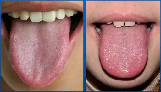 Comprehensive Guide to Tongue Diagnosis