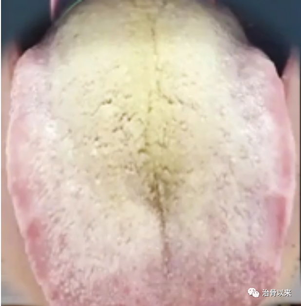 What Are the Manifestations of Cold Dampness, Damp-Heat, and Phlegm-Damp? How to Differentiate and Resolve Them