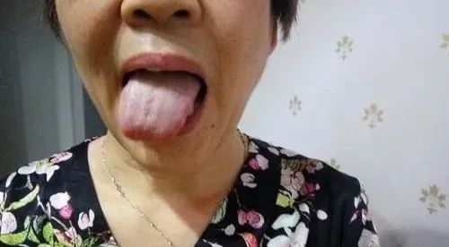 When Your Tongue Shows This Signal: Don't Delay!