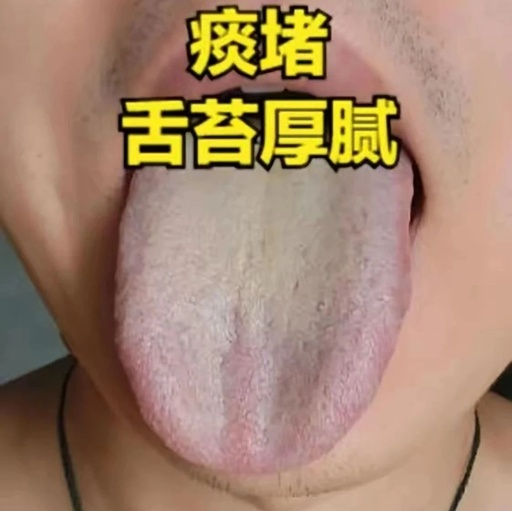 Three Tongue Manifestations Men Fear Most: Liver Qi Stagnation, Blood Stasis, and Phlegm-Dampness!