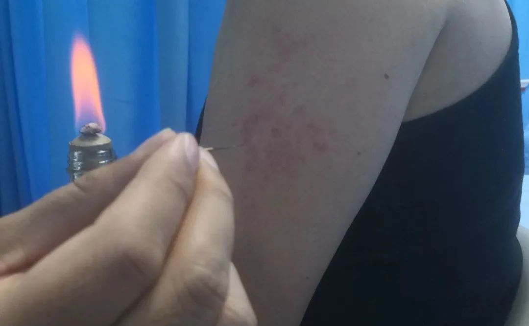 Exploring 'Fire Needle' as a Traditional Chinese Medicine Treatment for Herpes Zoster