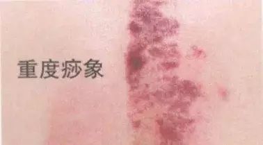 Analysis of Guasha Marks: Reflecting Different Health Conditions!