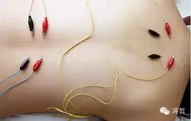 Acupuncture Treatment in Traditional Chinese Medicine