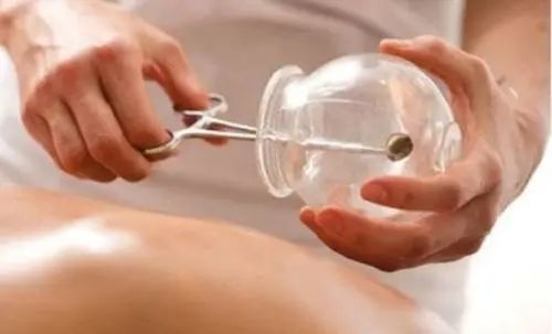 Cupping Therapy Techniques in Traditional Chinese Medicine