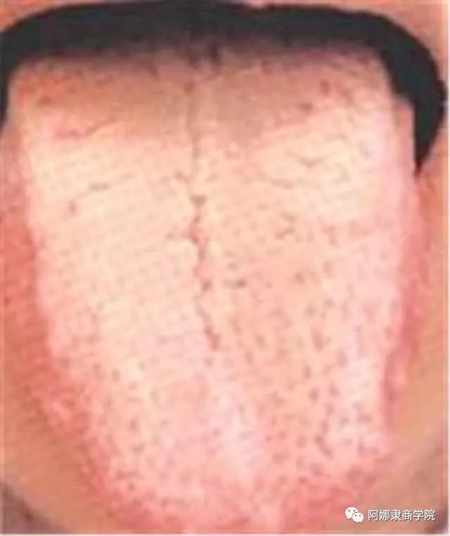 A Comprehensive Guide to 22 High-Definition Tongue Diagnosis Images: Understand Diseases Through Tongue Observation!