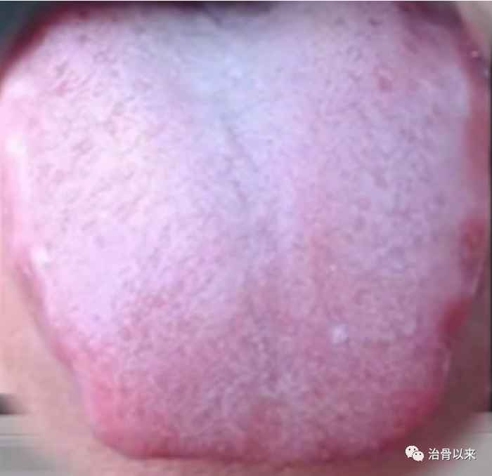 What Are the Manifestations of Cold Dampness, Damp-Heat, and Phlegm-Damp? How to Differentiate and Resolve Them
