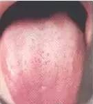 Comprehensive Guide to Tongue Diagnosis: Easily Understand Your Health Condition