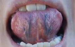 Three Methods to Detect Blood Stasis, Three Causes Explained, and Three Ancient Formulas to Eliminate Blood Stasis