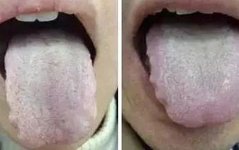 Understanding and Managing Phlegm-Damp Constitution in Traditional Chinese Medicine