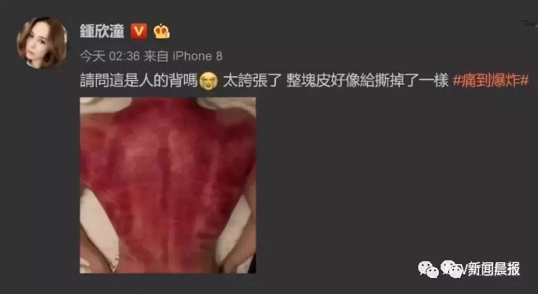 Caution: A Male Celebrity's Bare Back Photo Startles Netizens - Important Tips for Gua Sha This Summer