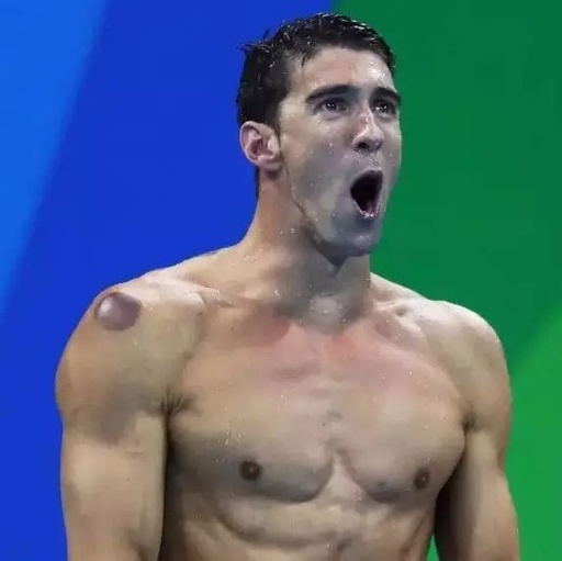 Cupping Therapy Gained Popularity at the Rio Olympics! But Not Everyone is Suitable for Cupping