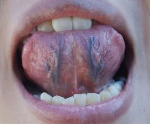 Three Methods to Detect Blood Stasis, Three Causes Explained, and Three Ancient Formulas to Eliminate Blood Stasis