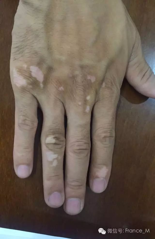 Fire Needle Therapy for Vitiligo