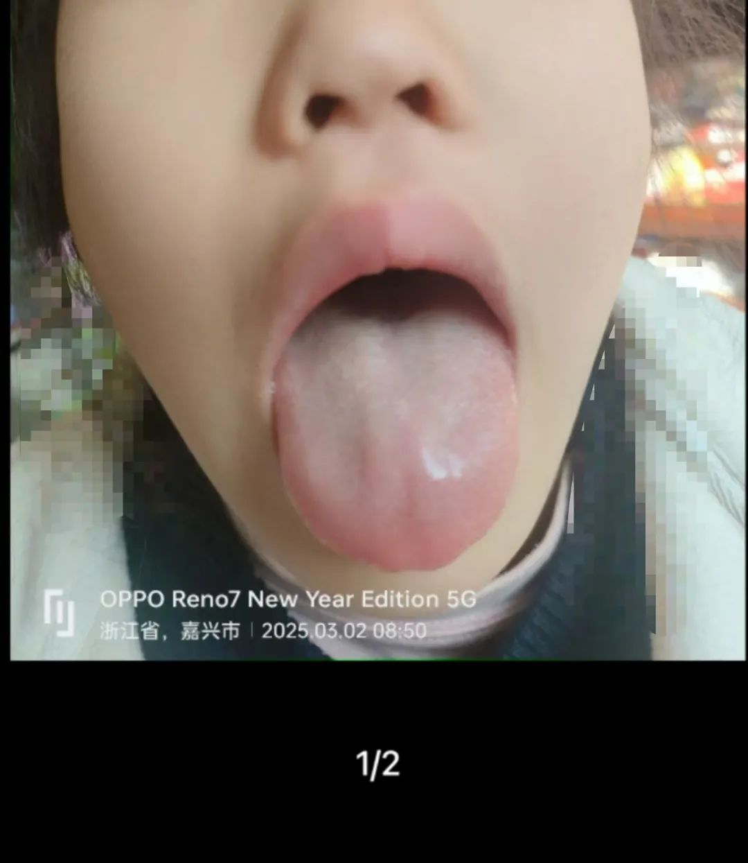 Don't Just Rely on Tongue Coating to Assess Health! There's More to It