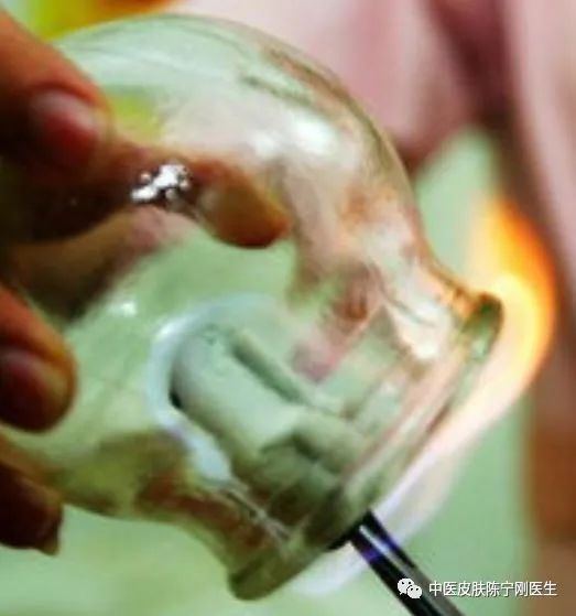 Cupping Therapy: A Traditional Method for Moisture Removal