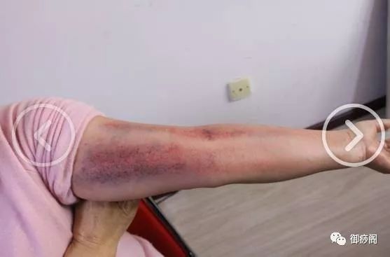 Why Gua Sha Should Not Be Limited to the Back: The Wonders of Gua Sha