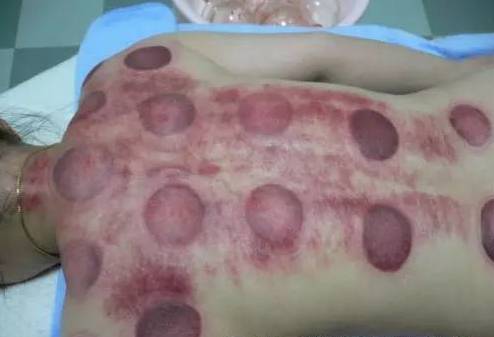 What Do Cupping Marks Indicate After Treatment?
