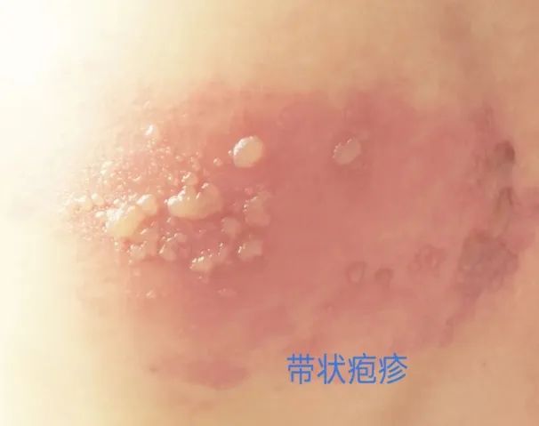 Fire Needle Therapy: A Unique TCM Approach