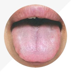 Understanding Tongue Diagnosis in TCM: Insights into Health from Tongue Appearance (Part 2)