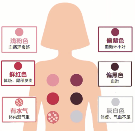 Cupping Therapy: A Traditional Chinese Medicine Approach to Health