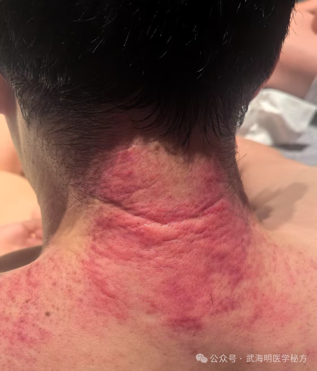 Gua Sha - Spring Health Tips