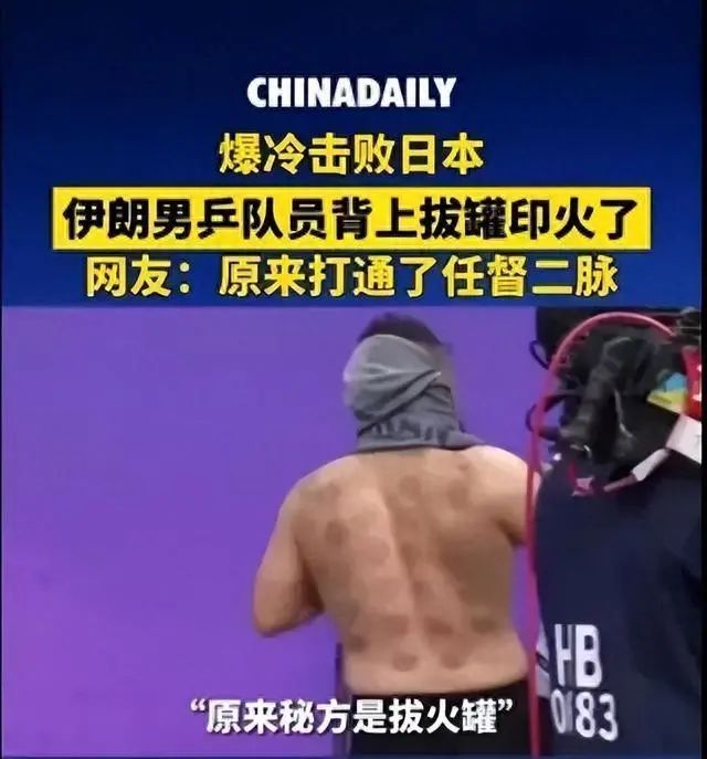 The Mysterious Eastern Power: Cupping Therapy at the Asian Games Village