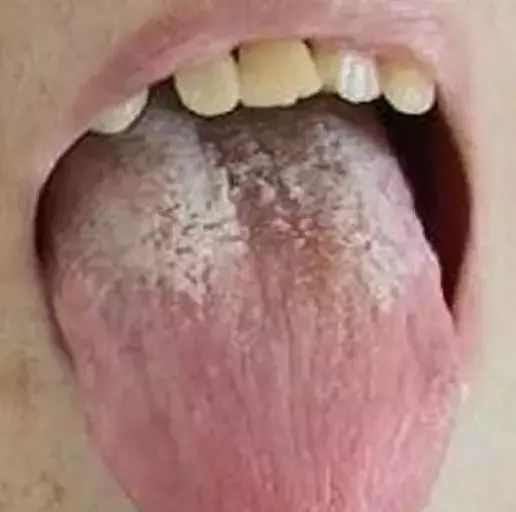 The Most Comprehensive Guide to Tongue Diagnosis! Master It and Become a Tongue Diagnosis Expert