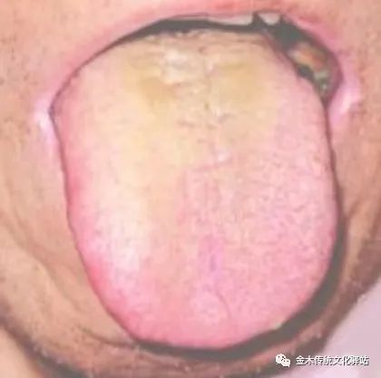 Tongue Diagnosis in Traditional Chinese Medicine: Characteristics of Tongue Coating