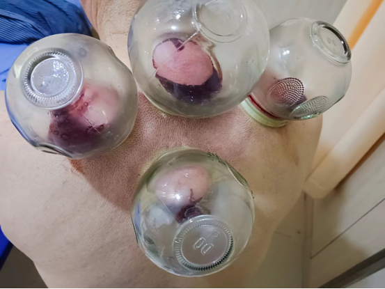 Traditional Chinese Medicine Therapy: Bloodletting Therapy