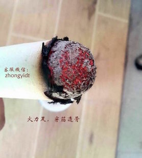 What to Do for Spleen and Stomach Yang Deficiency? - Moxibustion!