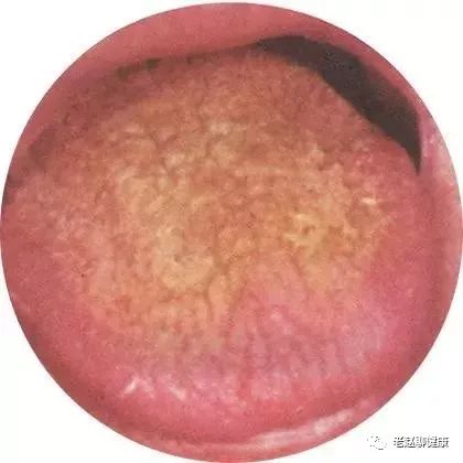 Learn Quick Ways to Observe Tongue Quality and Coating to Understand Your Health and Diseases!