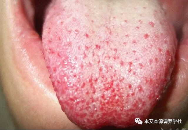Tongue Diagnosis Series 3: Precise Differentiation of Tongue Coating, Quality, and Shape