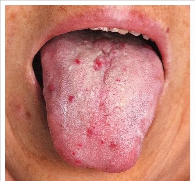 Traditional Chinese Medicine Tongue Diagnosis: 26 Clinical High-Definition Tongue Diagnosis Images with Analysis