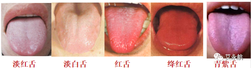 Understanding Disease Through Tongue Diagnosis in Traditional Chinese Medicine